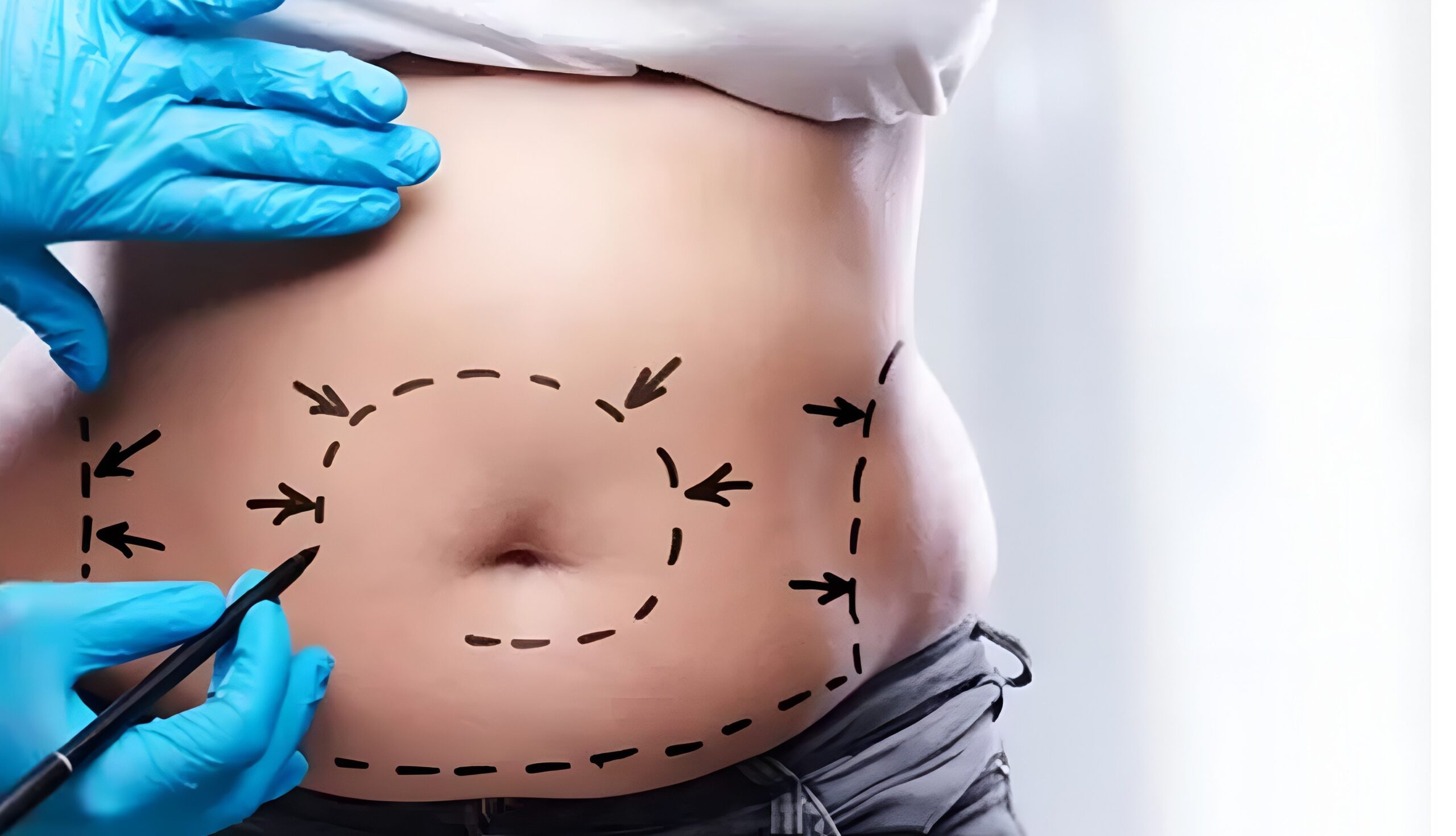 Liposuction